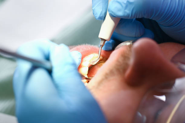 Best Emergency Treatment for Dental Infections or Abscesses in Paloma Creek, TX